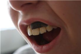 티백담배 스누스는 윗 잇몸과 입술 사이에 끼어서 이용한다.