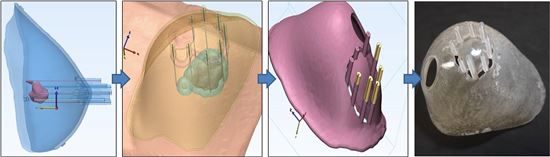 3D 프린터 활용 맞춤형 유방암 제거 수술한다