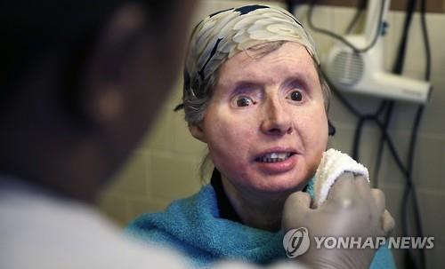침팬지에게 공격당해 안면이식 수술받은 여성, 거부반응으로 병원 입원