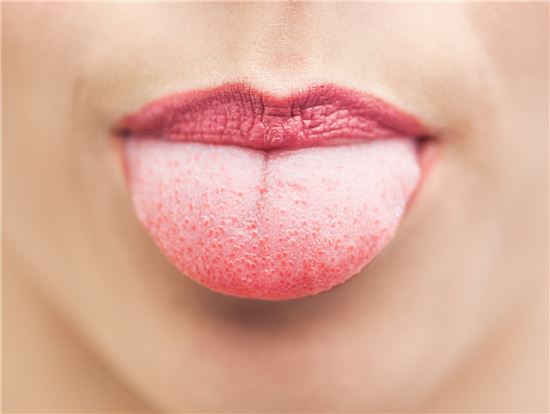 [건강을 읽다]혀가 화끈 화끈…구강작열감증후군?