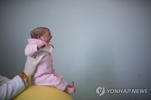 소두증 아기 / 사진 제공=연합뉴스