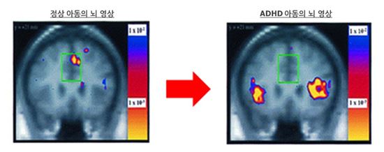 ▲정상아동(왼쪽)에게서는 집중력이 필요한 상황에서 활성화되는 등쪽 전방 중심부 대상피질(dorsal anterior midcingulate cortex)의 활성화가 ADHD 환자(오른쪽)에서는 관찰되지 않았다.[사진제공=대한소아청소년정신의학회]