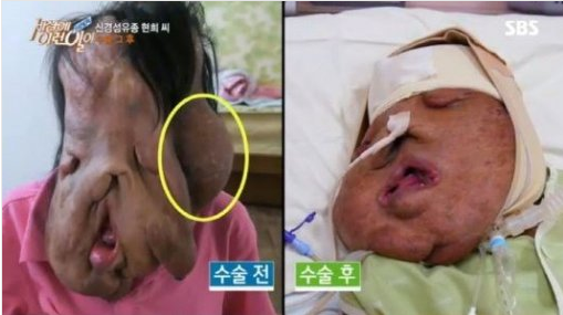 심현희씨가 혹1kg제거 수술을 무사히 마쳤다. /사진= SBS '세상에 이런일이'방송 캡처