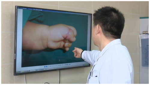 중국 장쑤(江蘇) 성 쉬저우(徐州) 시에 사는 왕씨가 태어난 지 며칠 안 된 아들의 왼손 엄지가 부푼 것을 발견하고 병원을 찾았다. 아들의 엄지는 머리카락이 묶여 있었고 피부가 깊게 파고든 상태였다/사진=  중국 'huaihai.tv' 방송 캡처