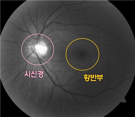 녹내장 조기 진단 가능해졌다