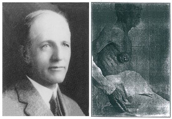 기록에 남은 국내 첫 남성 유방암 환자는 1923년 세브란스병원 러들로 교수가 남긴 수술 전 사진 속 인물로 우측 가슴 부분에 멍울이 진 것을 확인할 수 있다. 사진 왼쪽은 알프레드 어빙 러들로 교수, 오른쪽은 수술 전 촬영된 남성 유방암 환자의 1923년 모습 / 사진 = 세브란스병원 
