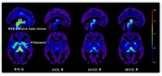 ▲국내 연구팀이 우울증·강박증 치료제를 복용한 후 나타나는 뇌 부위별 분포 차이를 확인했다.[사진제공=분당서울대병원]
