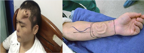 중국의 한 남성이 이식 수술을 위해 자신의 이마에 코를 배양하고 있는 모습. 미국의 한 여성이 이식 수술을 위해 자신의 팔에 귀를 배양하고 있는 모습. 사진=온라인 커뮤니티 캡쳐