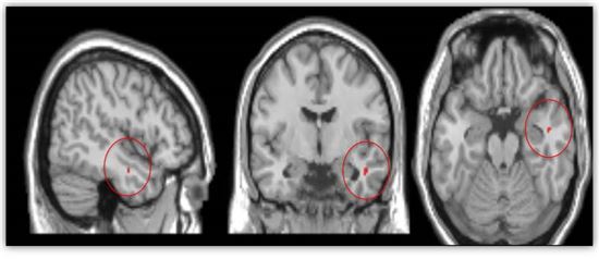 ▲수면무호흡증군의 우측 측두엽 피질(temporal cortex)에 아밀로이드가 침착된 부분을 붉은색으로 표시했다.[사진제공=분당서울대병원]
