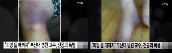23일 YTN는 2014년과 2015년 부산대병원 전공의 11명이 지도교수에게 폭행을 당했다며 병원에 제출한 사진을 유은혜 더불어민주당 의원실을 통해 입수해 공개했다. /사진=YTN 캡쳐