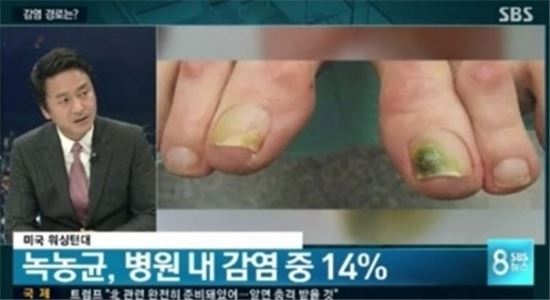 녹농균, 다양한 감염경로 속 누리꾼 "그래도 개물림이 원인"