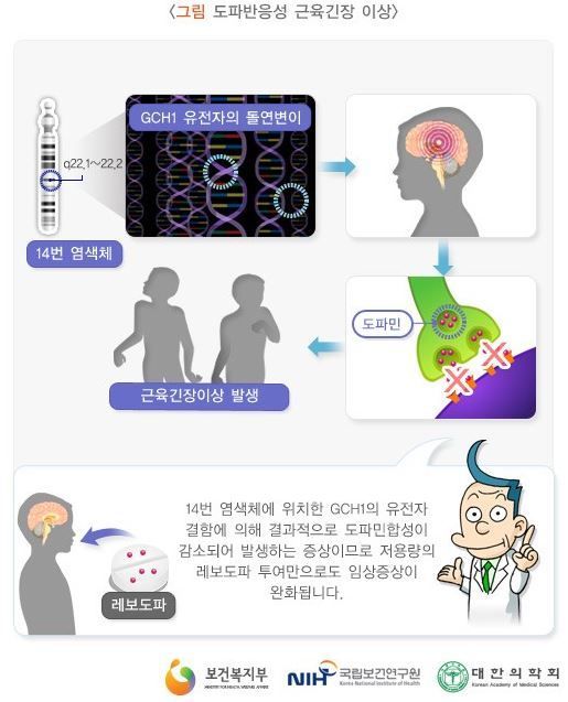 세가와병(도파 반응성 근육긴장이상)/ 사진=국립보건연구원 희귀난치성질환센터