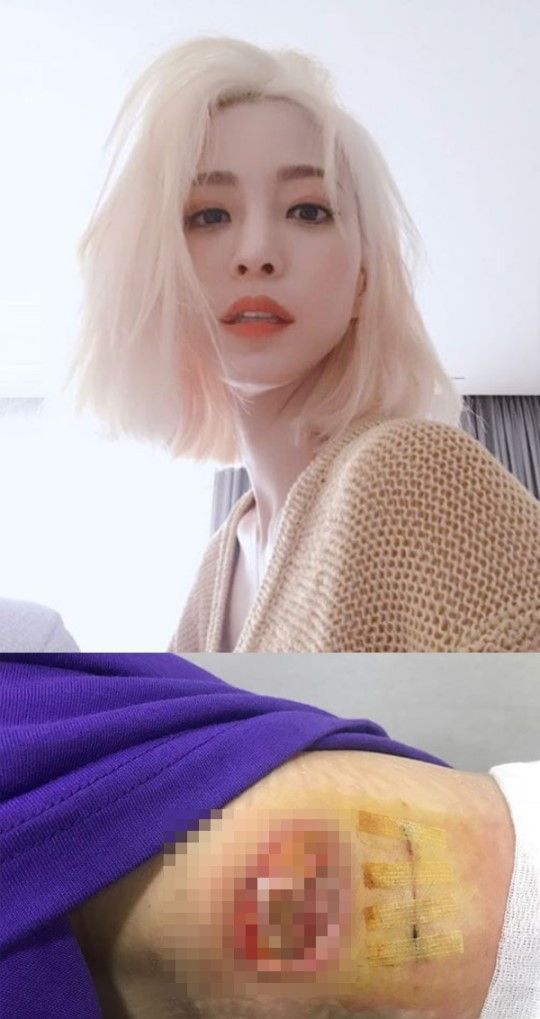 한예슬 의료사고에 네티즌 "치료해도 흉터 남을텐데…"