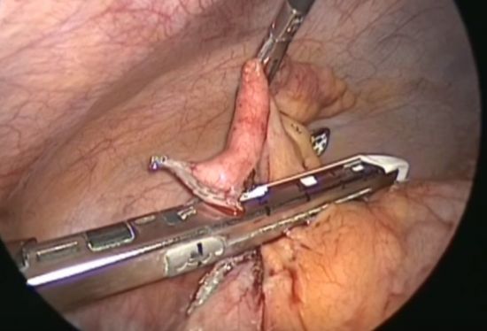 [과학을 읽다]맹장 없어도 우주선 탈 수 있다?