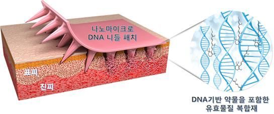 세계 최초 '나노마이크로 DNA 니들패치' 상용화 