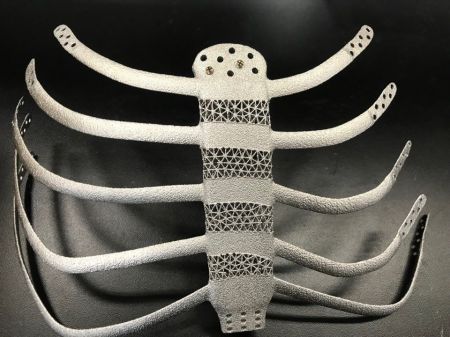 중앙대병원, 국내 최초 3D프린팅 인공흉곽 이식 성공…세계 6번째