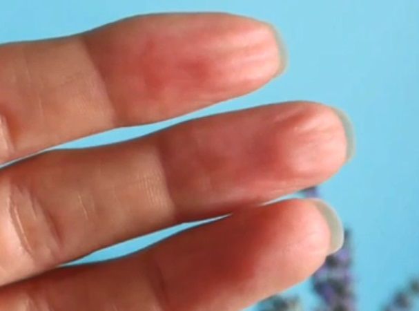 [과학을읽다]지문 없는 사람?