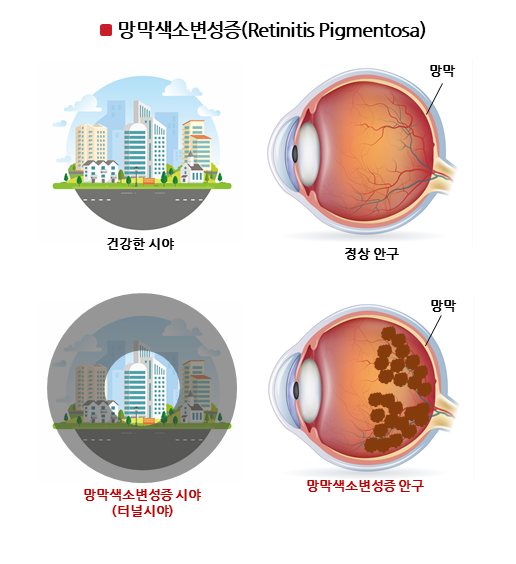 올릭스, 망막색소변성증 신약 개발…"글로벌 탑 5, 안과 신약 기업 목표"