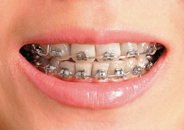 [콕!건강]치아 교정치료 중이라면…이것만큼은 피해야