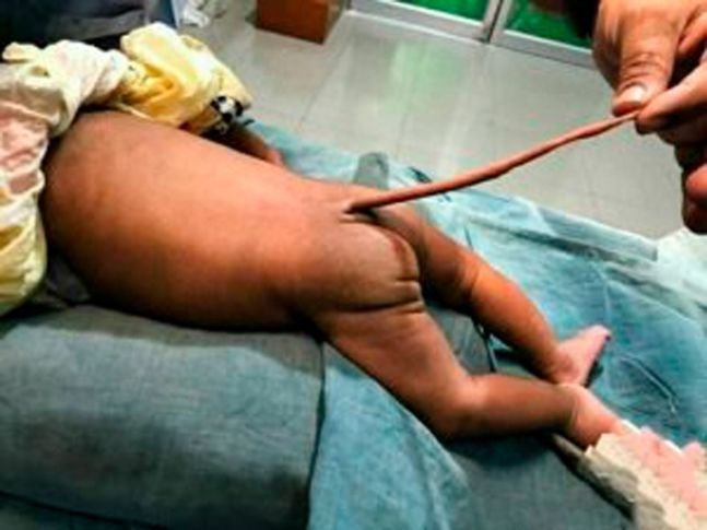 지난 18일(현지시간) 콜롬비아 한 병원에서 퇴화한 꼬리를 가진 아기가 탄생했다. / 사진=인터넷 홈페이지 캡처
