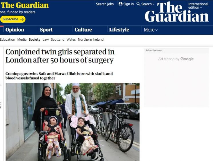 머리 붙은 채 태어난 희귀 샴쌍둥이 자매, 50시간 대수술서 분리 성공