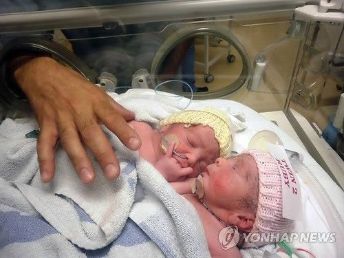 2012년 7월27일 영국의 한 병원에서 태어난 샴쌍둥이 자매 로지(좌)와 루비(우)/사진=연합뉴스