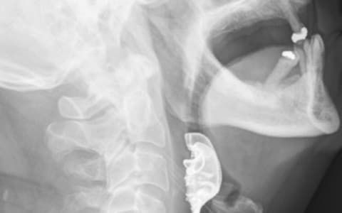 수술 중 삼킨 틀니가 후두에 걸려 있는 모습./사진=영국의학저널(BMJ) 제공