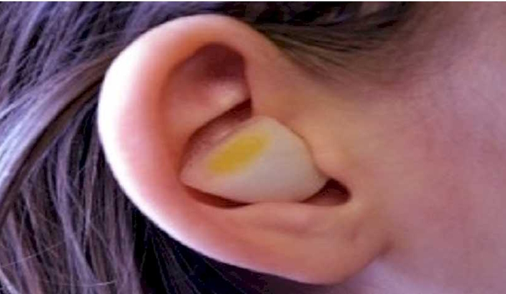 귀에 양파조각을 꽃으면 귓병이 낫는다는 낭설도 과학적 근거없이 유행했다.(사진=온라인 커뮤니티)