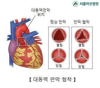 "대동맥판막협착증, 증상 없어도 수술이 낫다"..해법 제시한 韓 의사