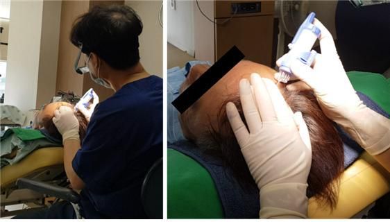 '개틀링 모발이식' 탈모고통 절반으로 줄인다