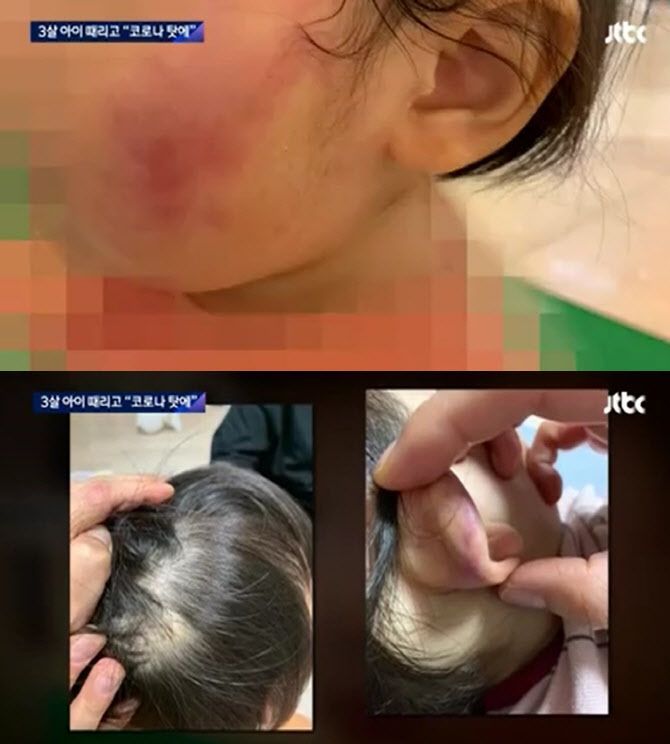 지난 1일 경기 파주 한 어린이집 원장 A 씨에게 폭행 당한 피해 아동 / 사진=JTBC 방송 캡처