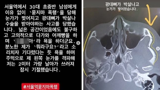 이른바 '서울역 묻지마 폭행 사건'의 피해자가 자신의 SNS에 올린 게시물. 사진=온라인 커뮤니티 캡처