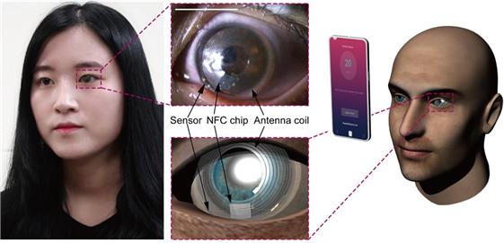 이번 연구로 개발된 스마트 콘텍트렌즈는 실제 소프트 콘택트렌즈 제작에 사용되는 물질로 제작됐다. 이물감이 적으며 안전하다. 스마트 렌즈를 착용한 후 스마트폰을 눈 주위로 가져가 태그하면 정확한 스트레스 호르몬 수치를 실시간으로 확인할 수 있다.