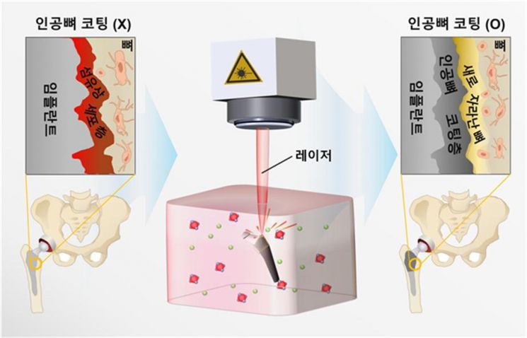 '인공뼈 임플란트' 쉽게 만든다.. 염증 없고 잘 붙어