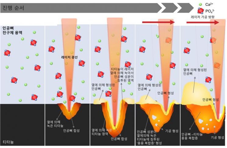 '인공뼈 임플란트' 쉽게 만든다.. 염증 없고 잘 붙어