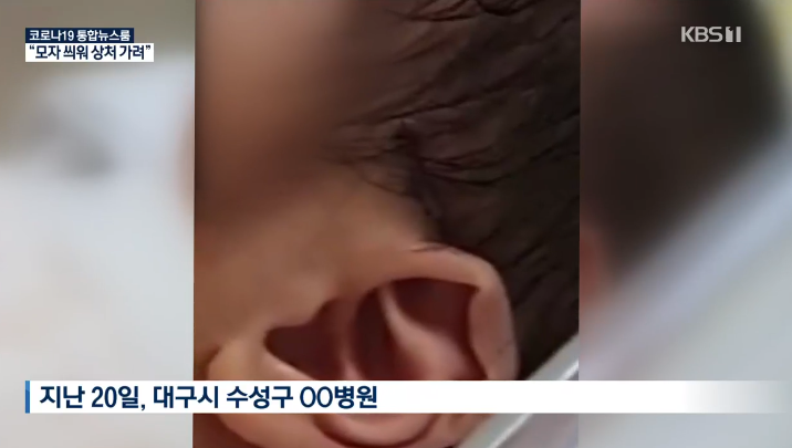 신생아 머리에 칼자국…병원측 은폐·부실대응 논란 