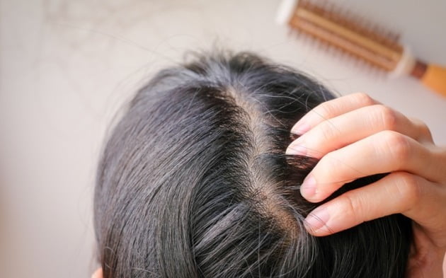 최근 20~30대부터 탈모를 고민하거나 탈모 약을 복용하는 '젊은 탈모인'들이 빠르게 늘고 있다. /사진=게티이미지뱅크