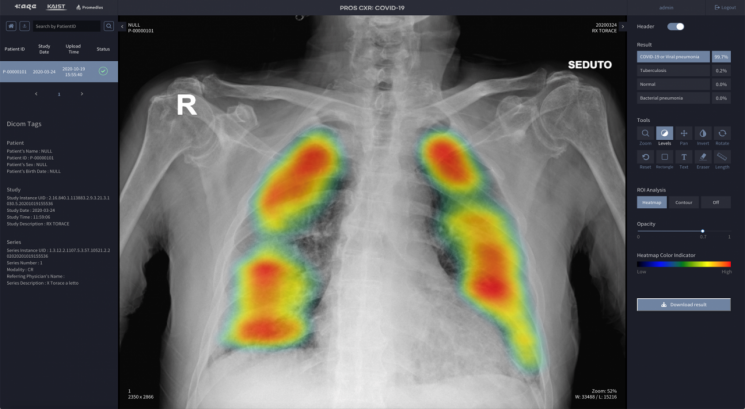 인공지능 chest -xray 신속진단 . 사진제공=한국과학기술원(KAIST)