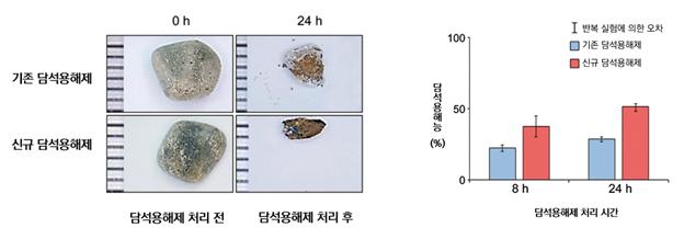 부작용無 효과↑…담석 용해제 곧 시판 된다