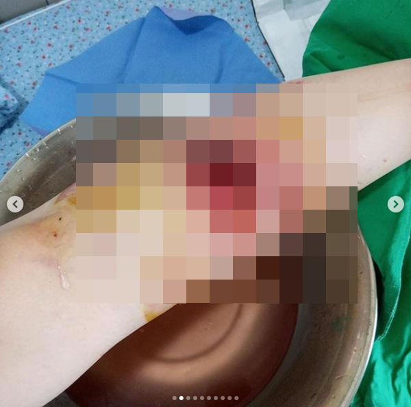 "맹견에 물려 끌려다녔다" 애견카페서 일어난 끔찍한 개 물림 사고