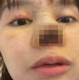 무면허 성형 수술로 코가 괴사한 중국 배우 가오 류. 사진=가오 류 웨이보 캡처.