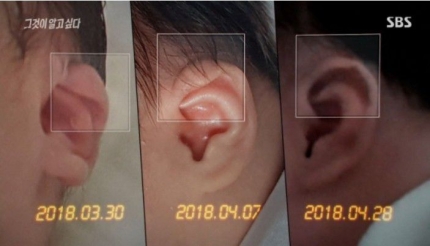 4월 24일 이후 변화한 구미 3세 여아 왼쪽 귀 모양 사진. [사진= SBS '그것이 알고싶다']