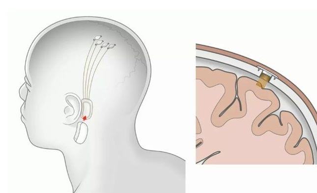 뉴럴링크의 컴퓨터 칩 구상도. 두개골을 뚫고 뇌에 침입하는 미세한 전극을 심어 작동한다. / 사진=뉴럴링크