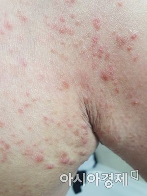 목포 한 요양병원 입원환자 A씨에게 발생한  옴 질환 / ⓒ 아시아경제