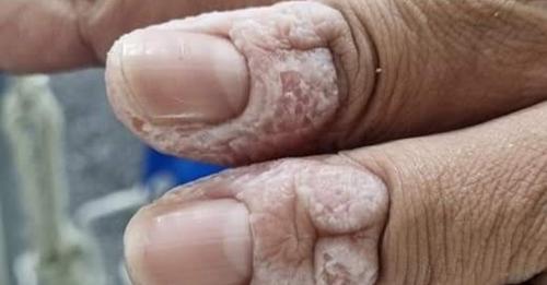이재명 경기도지사가 20일 페이스북에 올린 코로나19 현장에서 사투를 벌이는 어느 간호사의 퉁퉁부은 손가락