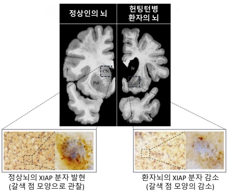韓 연구진, '불치병' 헌팅턴병 치료에 '돌파구'