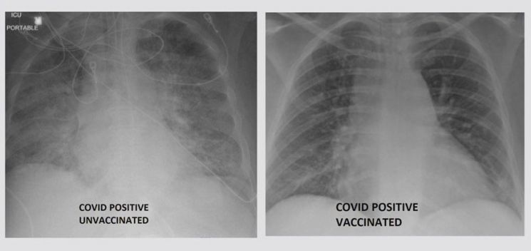 왼쪽은 백신을 맞지 않은 상태에서 코로나19에 확진된 폐의 모습. 오른쪽은 백신을 맞은 상태에서 코로나19에 확진된 폐의 모습. 왼쪽이 오른쪽보다 흰 부분이 많다. (사진제공=KSDK)