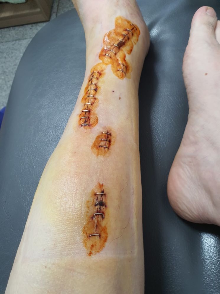 30년 방치된 인도 위의 ‘지뢰’ … 맨홀 철판 밟고 미끄러져 중상입은 보행자에 ‘나 몰라라’