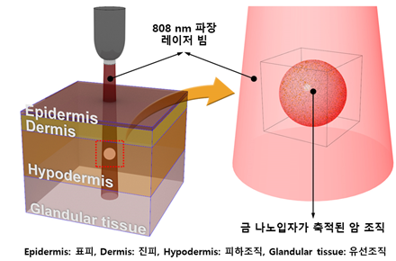 '수술·항암제 없는' 피부암·유방암 치료법 임상 적용 급물살