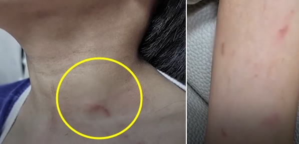 지난 6월부터 아이의 목과 팔에 생긴 상처. /사진=YTN 뉴스화면 캡처